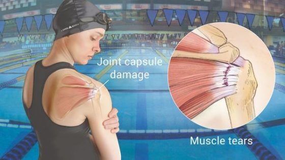 What Should You Know About Swimmer's Shoulder | Playo