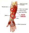 Forearm Tendonitis Injury: All you need to know | Playo